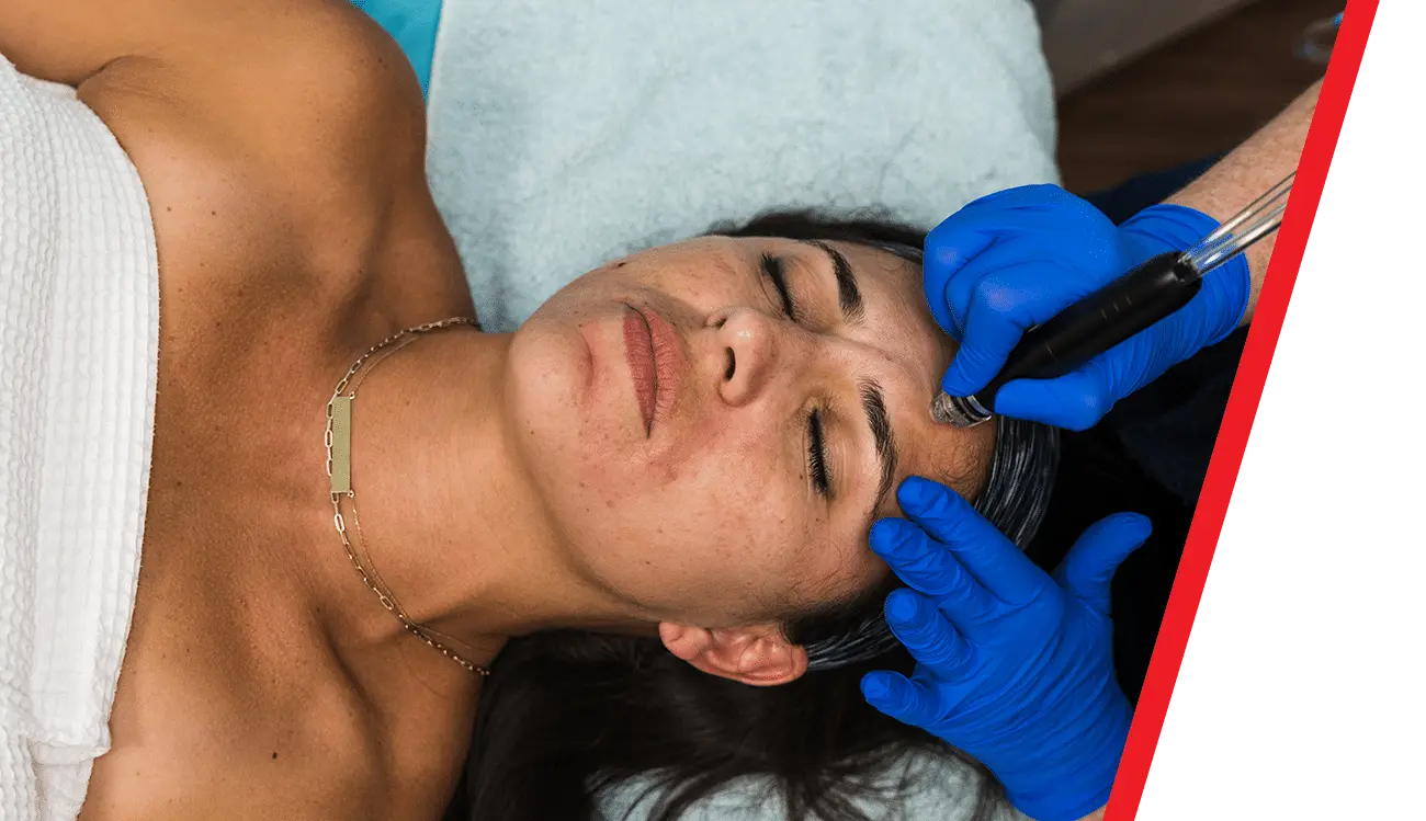 Microneedling